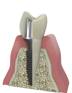 Имплантат зубной